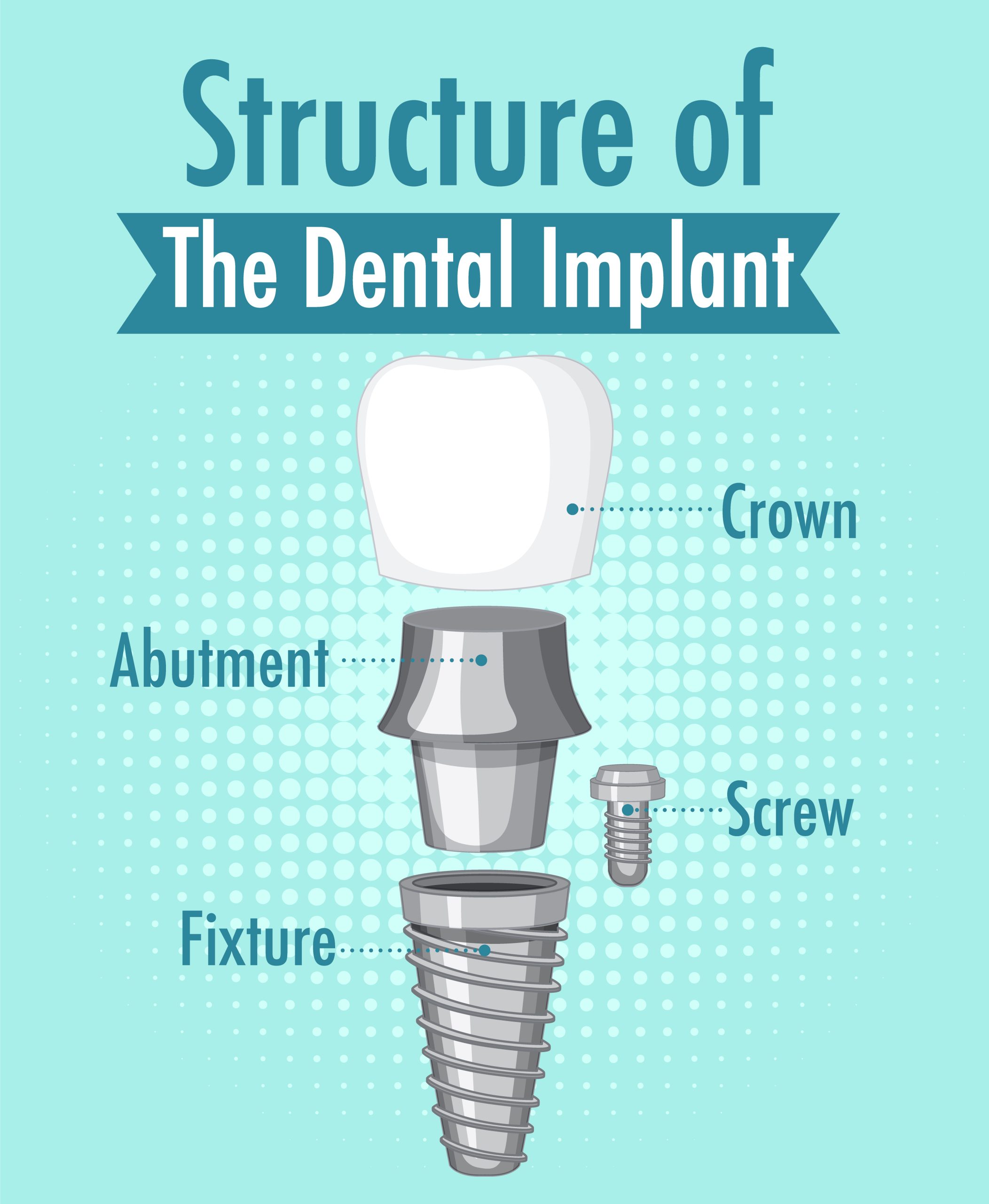 Infographic of human in structure of the dental implant illustration
