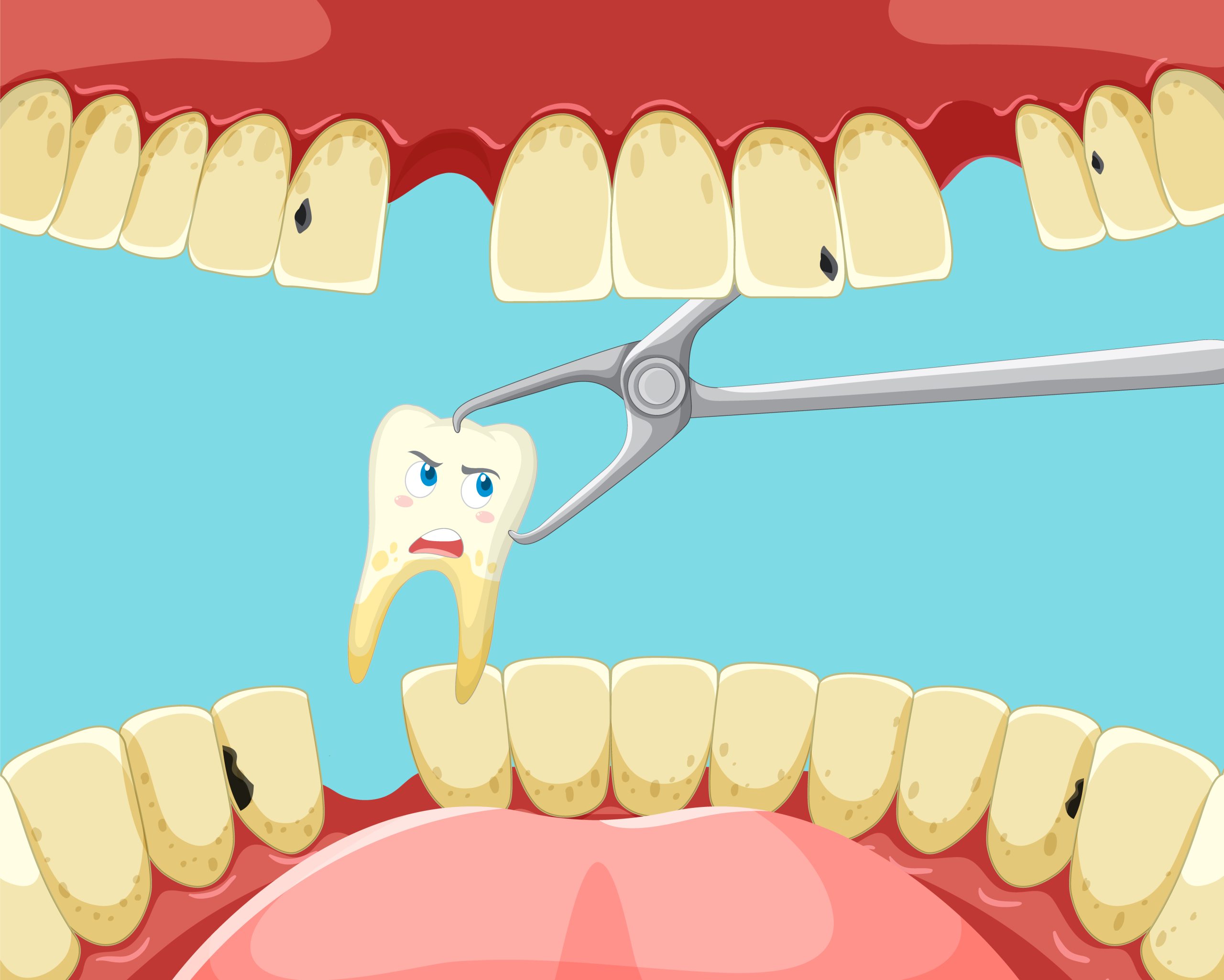 Tooth extraction inside human mouth illustration