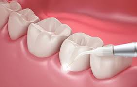 Laser Dentistry
