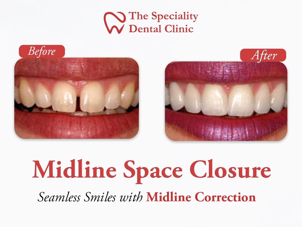 Midline