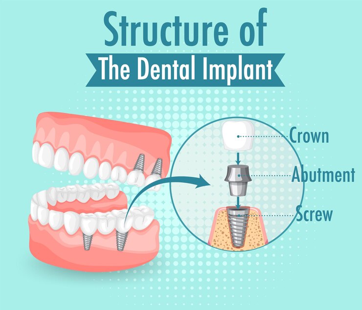 dental-implants