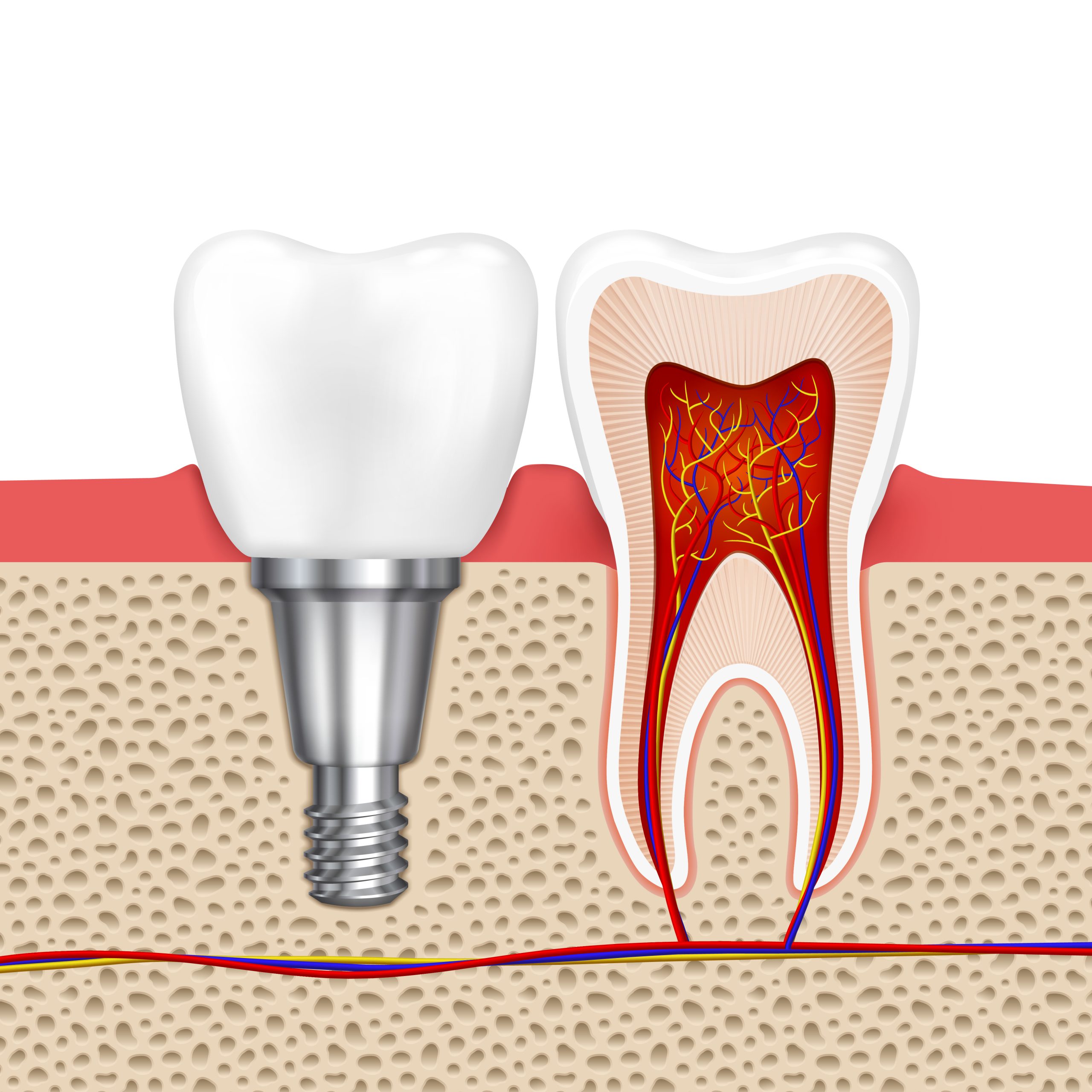 Healthy teeth and dental implant. Implant tooth, health tooth medical dentistry, vector illustration