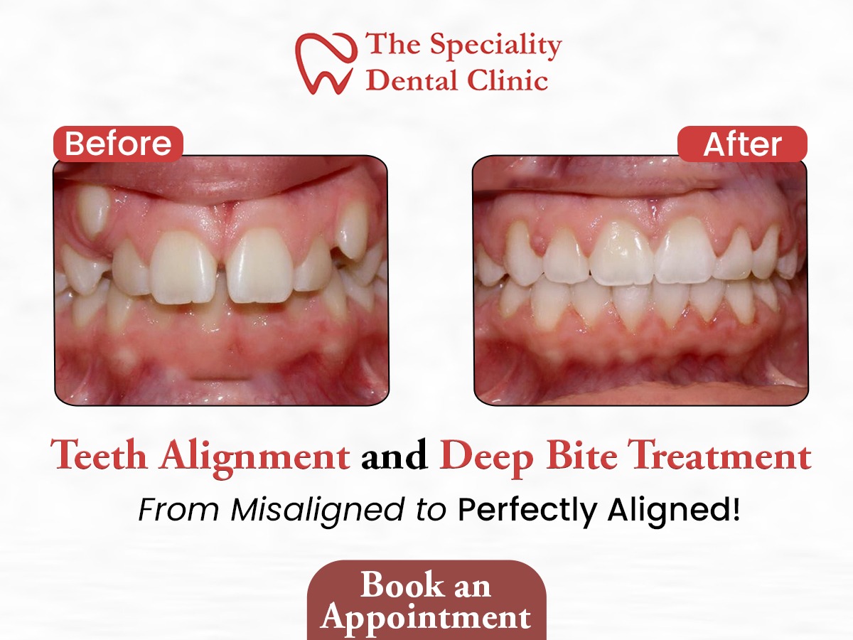 teeth-aligners